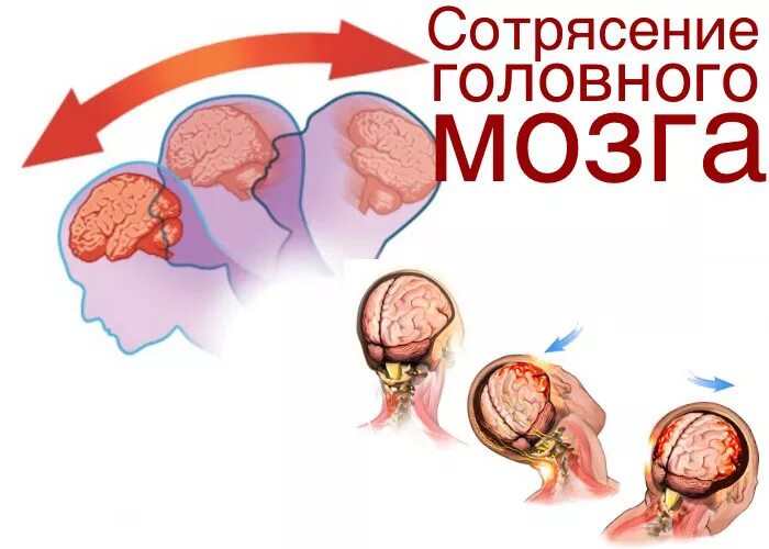Симптомы сотрясения головного мозга у детей - Всё о головной боли