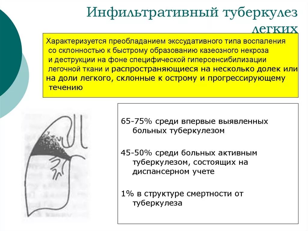 Инфильтративный распад легких