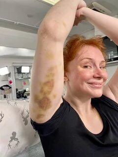 Bryce Dallas Howard Shows Off Massive Bruises from Doing Stunts for Jurassi...