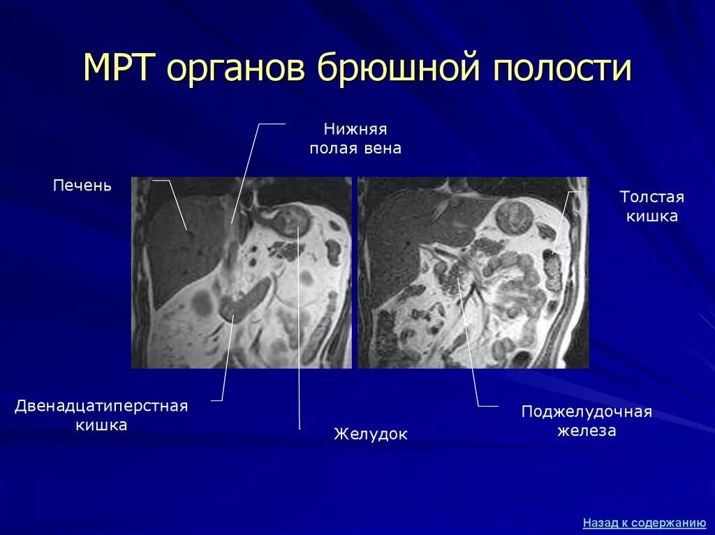 Мрт обп с контрастированием. Мрт брюшная полость и забрюшинное пространство. мрт органов забрюшинного пространства. брюшная полость мрт анатомия. мрт органов брюшной полости.