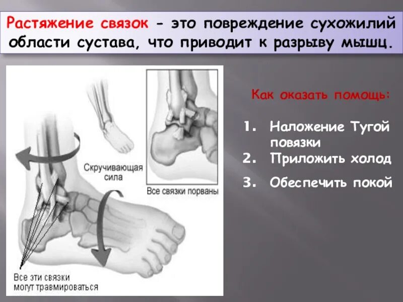 Как определить растяжение. Оказание первой помощи при растяжении и связок сухожилий мышц. растяжение и разрыв связок.