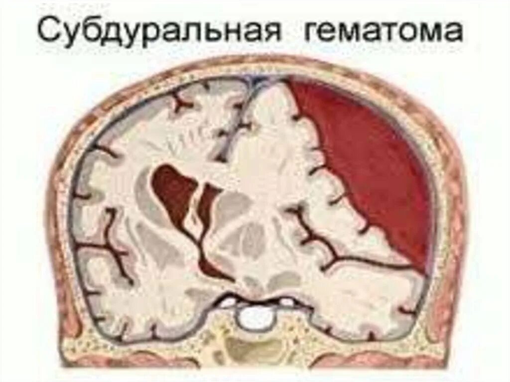 Внутричерепная субдуральная гематома. Сдавление головного мозга гематомой. Плащевидная субдуральная гематома. Субдуральное кровоизлияние головного мозга.