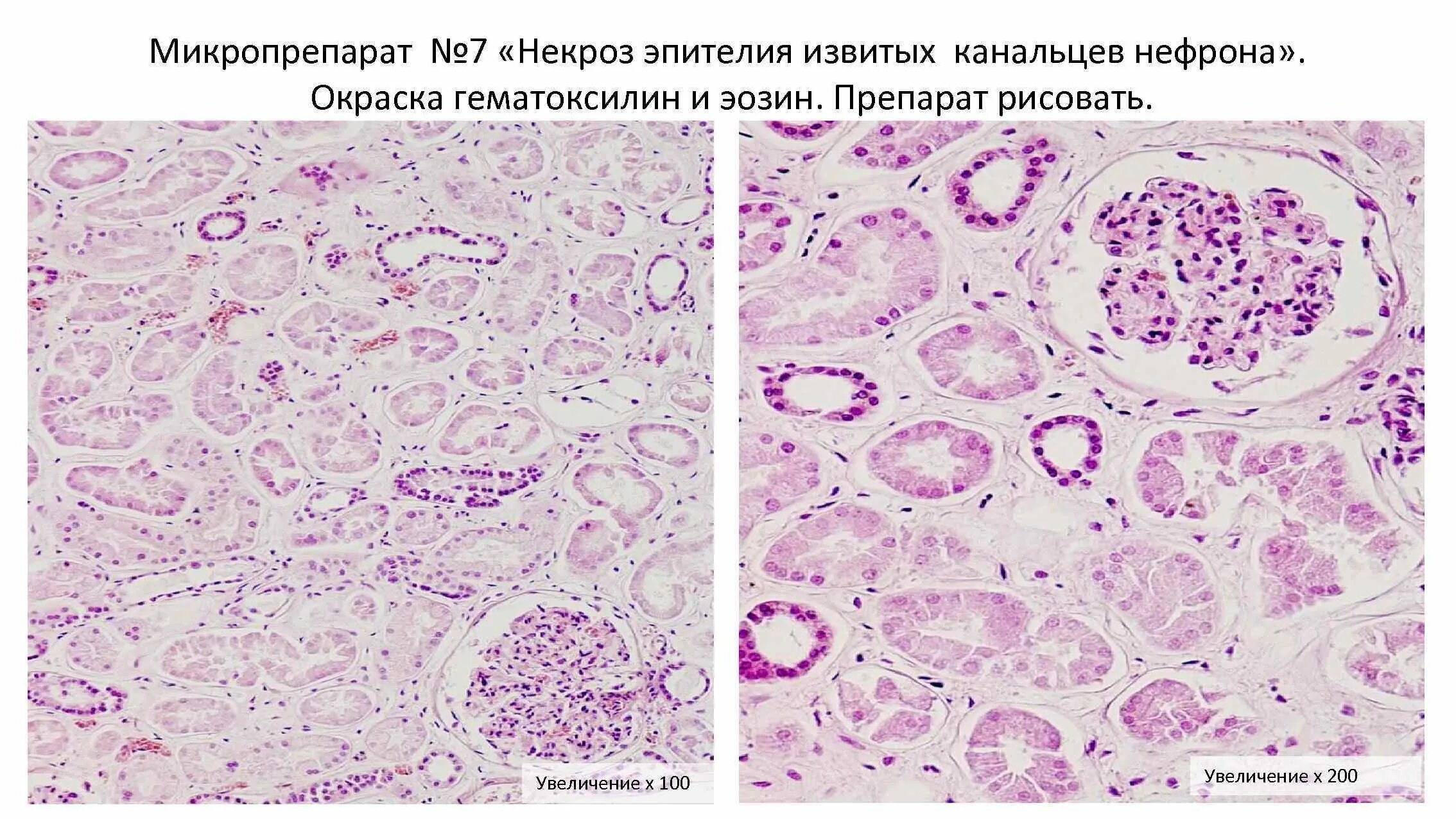 Пиелонефрит микропрепарат. Некроз почечного эпителия микропрепарат. Некроз эпителия канальцев микропрепарат. Эпителий извитых канальцев почки. Некроз эпителия извитых канальцев почки микропрепарат.