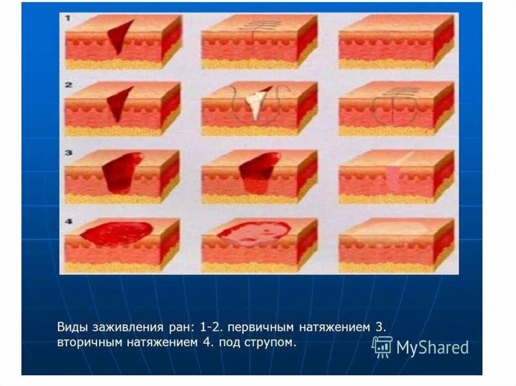 Через сколько заживает рана. Заживление раны (раневой процесс). Типы заживления РАН вторичным натяжением. Типы заживления РАН под струпом. Этапы заживления резаной раны.