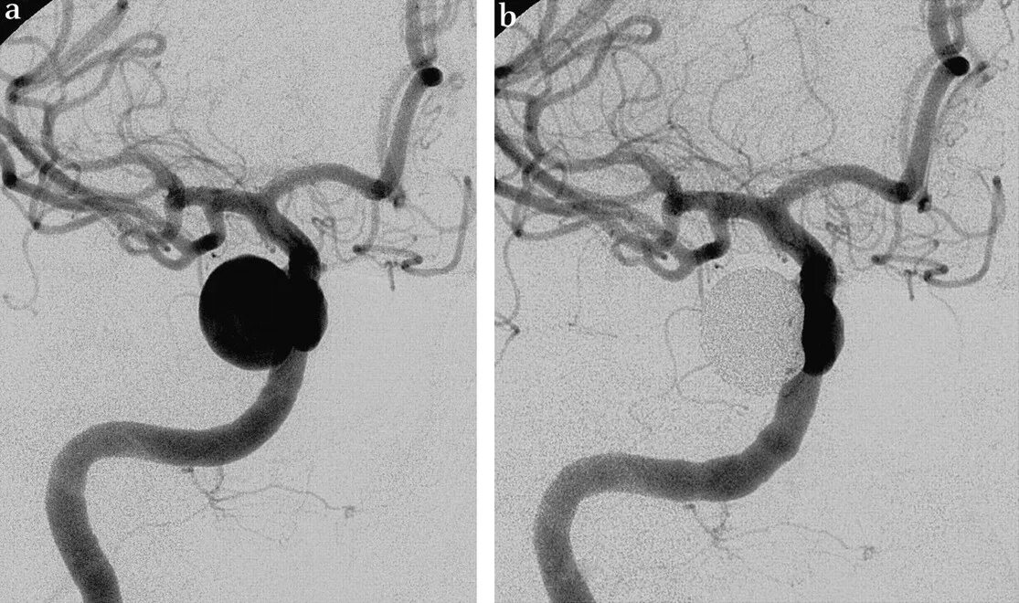 Эндоваскулярная операция аневризмы головного. Аневризма селезеночной артерии. Эмболизация мешотчатой аневризмы. Эндоваскулярная хирургия аневризм артерий головного мозга. Эндоваскулярная эмболизация аневризмы.
