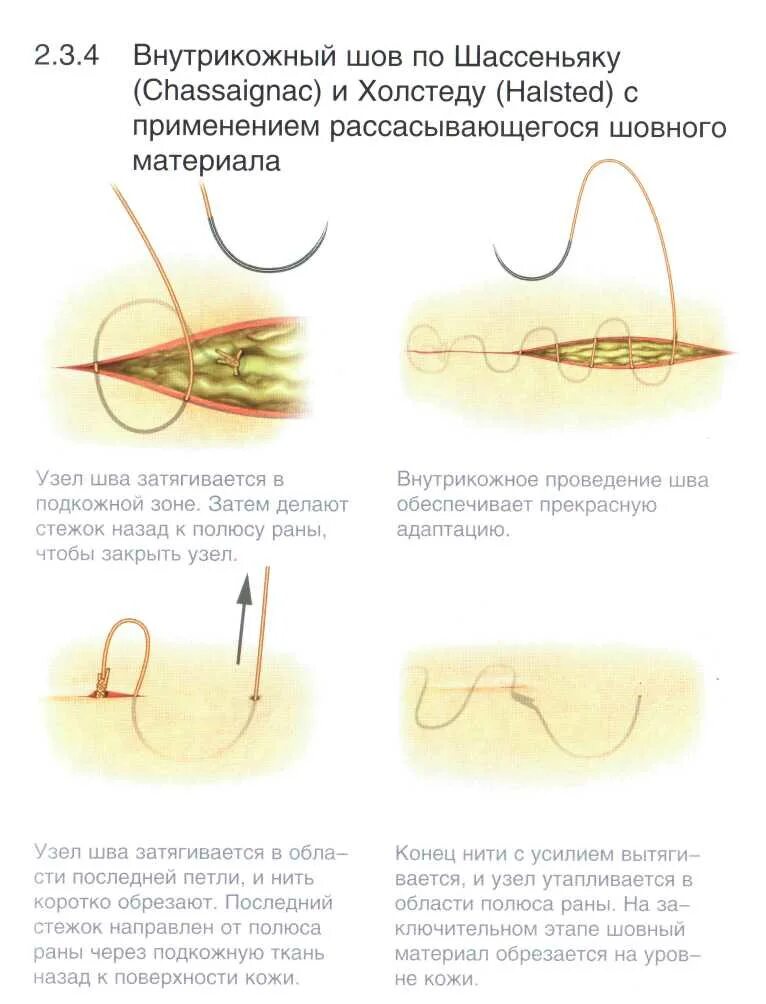 Kak dolgo. Косметический шов по Шассеньяку. Косметический шов внутрикожный. Косметический внутрикожный шов техника наложения. Внутрикожный шов по Холстеду Шассеньяку.