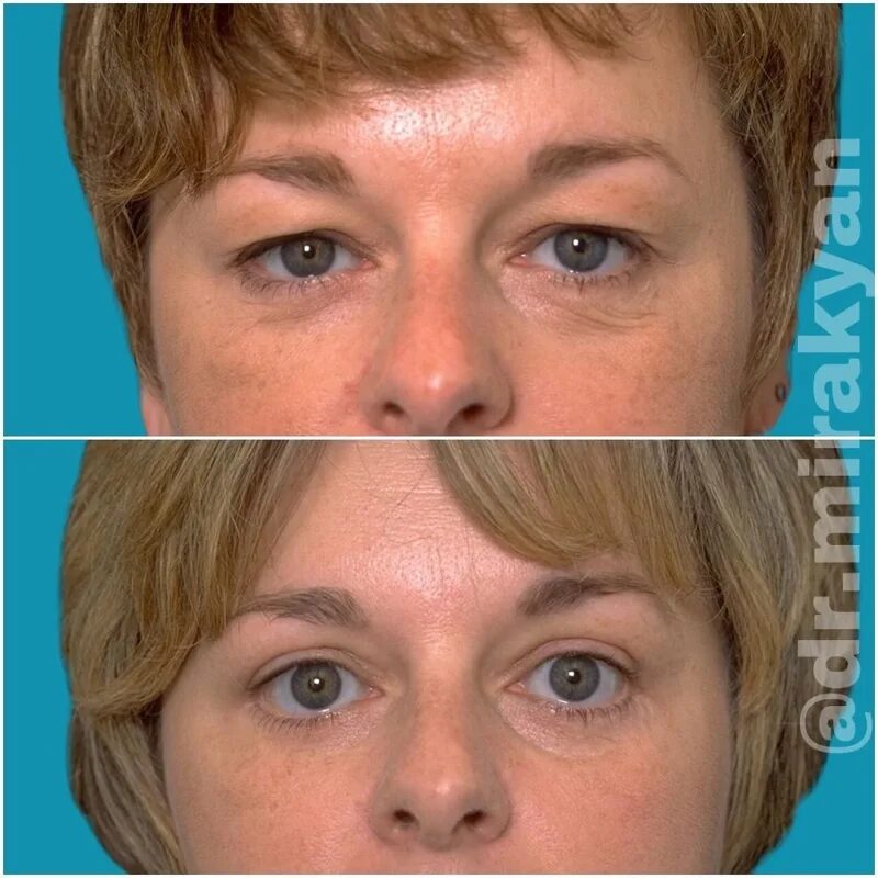 Пластика нижних век (блефаропластика) (нижняя). Подтяжка верхнего века без операции. Лифтинг для коррекции верхнего века. Безинъекционная блефаропластика век. Лифтинг век без операции.