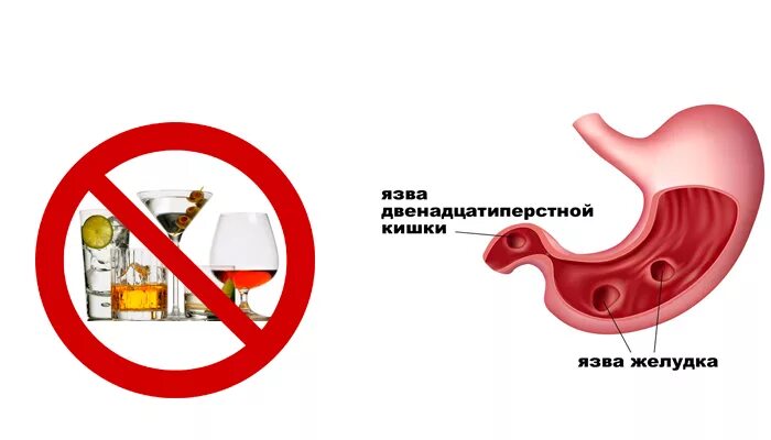 Можно вино при язве. Памятка профилактика язвенной болезни желудка. язвенная болезнь 12 перстной кишки профилактика. язвенная болезнь желудка и дпк профилактика. язвенная болезнь желудка и 12 перстной профилактика.