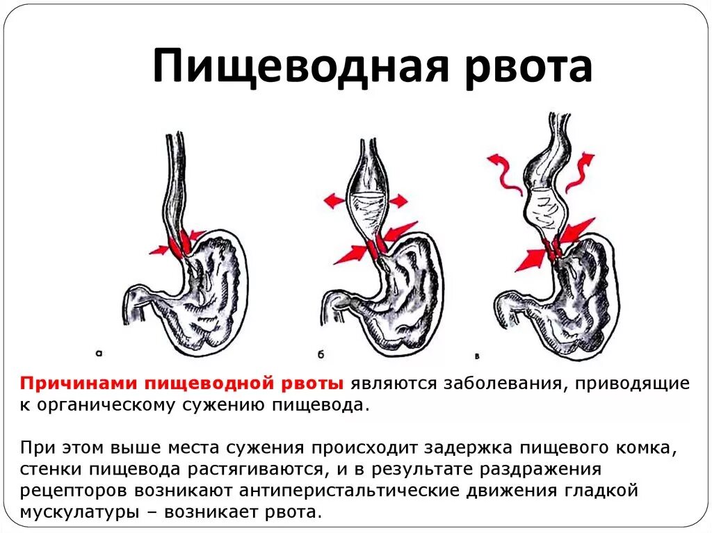 Почему чувство тошноты. Как происходит тошнота. Причины рвоты. Пищеводная рвота. Причины тошноты и рвоты.