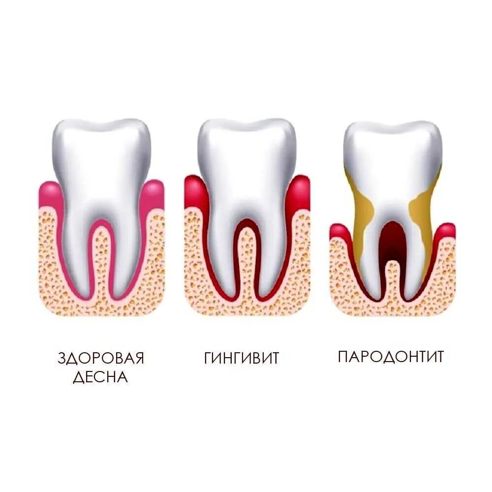 Признаки стороны зуба. Десквамативный гингивит. Воспаление десен пародонтит. Заболевание гингивит пародонтит. Гингивит пародонтит периодонтит.
