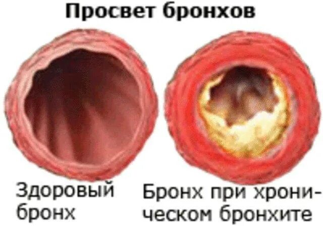 Это бронхит на целлюлит на. Воспаление слизистой оболочки бронхов. Острое воспаление слизистой оболочки бронхов. Острый и хронический бронхит.