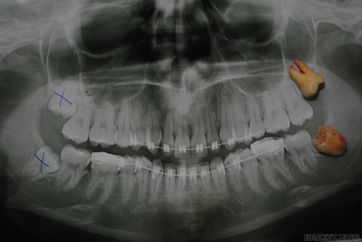 Лечат 8 зуб. Ретинированный дистопированный зуб мудрости. Ретинированного дистопированного зуба. Ретинированный зуб мудрости снимок.