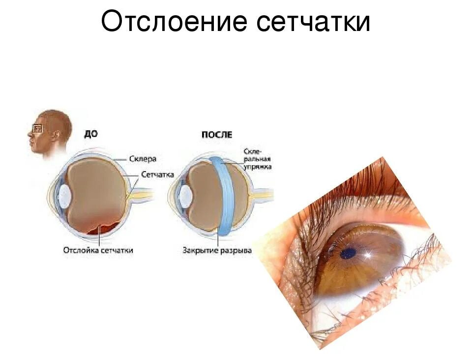 Отслойка сетчатки глаза причины. Отслойка сетчатки глаза симптомы. Отслойка эпителия роговицы. Признаки отслоения сетчатки глаза.