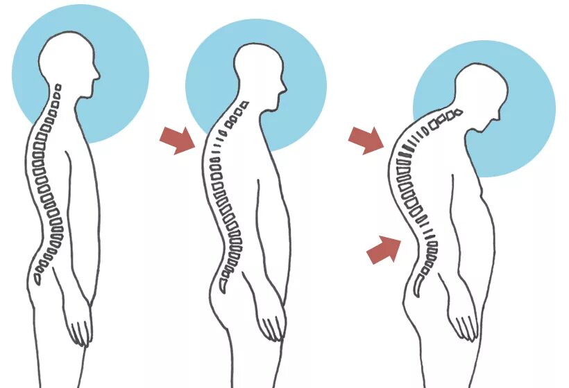 Кифоз шейно грудного отдела позвоночника. Искривление позвоночника кифоз. Искривление позвоночника лордоз кифоз сколиоз.