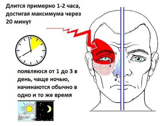 Сильная головная боль лоб и виски. Белигол ава. Головная боль. Причины головной боли. Головная боль схема.