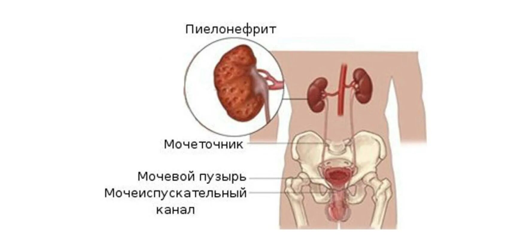 Пиелонефрит у мужчин лечение. Пиелонефрит у мужчин лечение