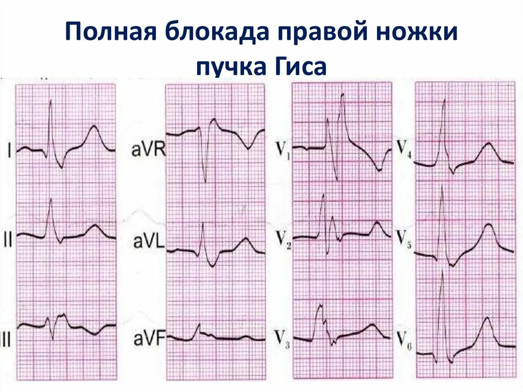 Блокада левой ножки пучка гиса на экг