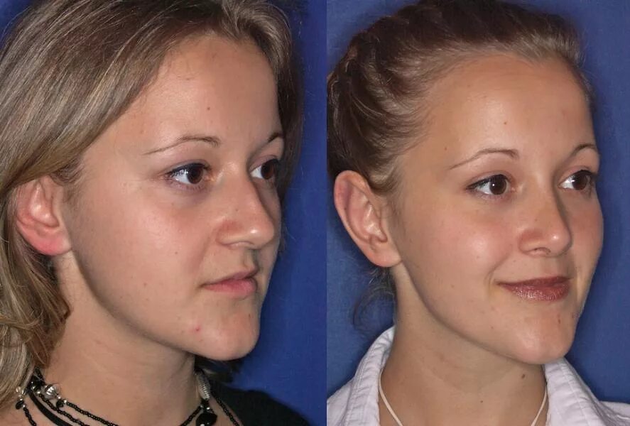 пластика кончика носа. гасан ашаханович риносептопластика. пластика носа. седловидный нос ринопластика. пластика лица нос.