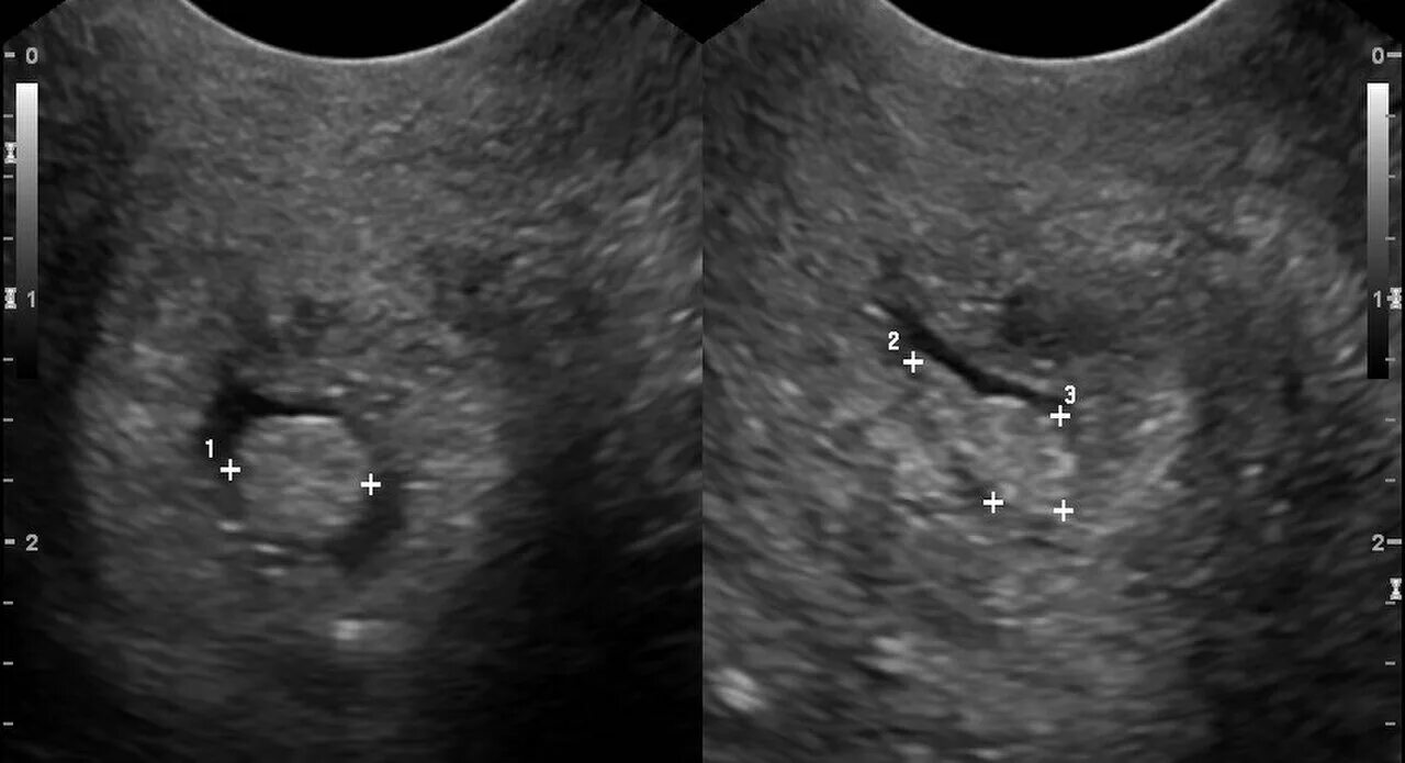 Полость матки 10. Полип эндометрия и цервикального канала.