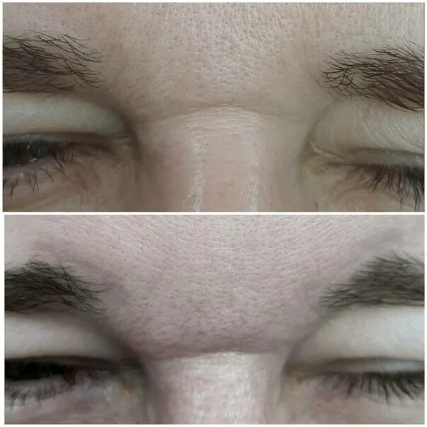 Глубокая морщина на переносице. Вертикальные морщины между бровями. Горизонтальная складка на переносице. Глубокая морщина на переносице. Глубокая морщина на переносице.