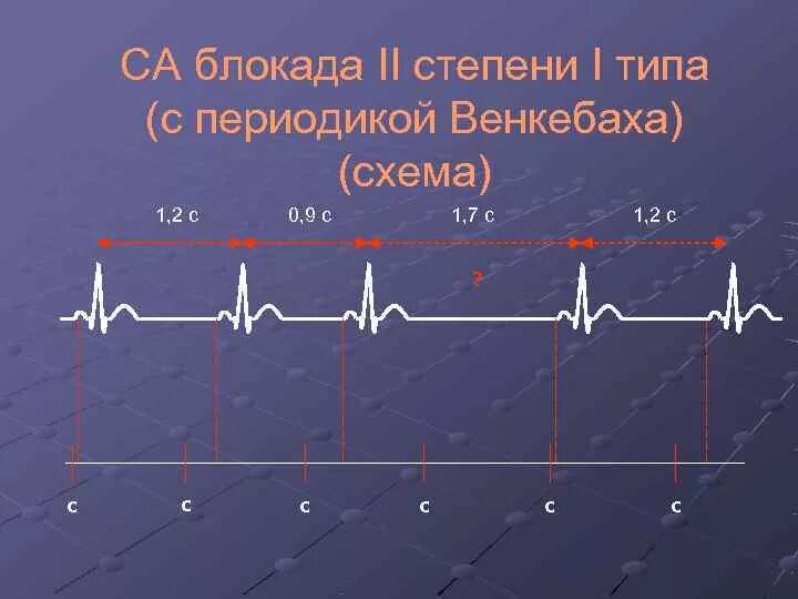 Блокада узла. Синоатриальная блокада 2 степени 1 типа. Синоатриальная блокада 2 степени типа Мобитц 1. Синоатриальная блокада 2 степени 2 типа. Са-блокада II степени Мобитц 2.