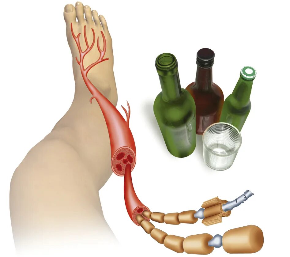 Алкогольная полинейропатия нижних конечностей симптомы