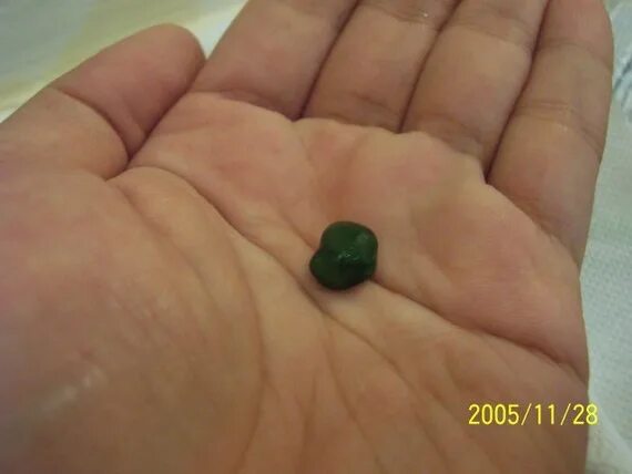 Зеленые билирубиновые камни. Из желчного вышел камень самостоятельно