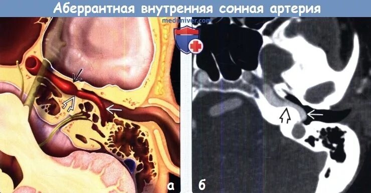 Аберрантная подключичная артерия кт. Аберрантная почечная артерия кт. Аберрантная правая подключичная артерия кт. Аберрантная внутренняя Сонная артерия.