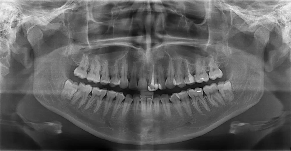 Снимок. Ортопантомография пародонтит. ОПТГ зубных рядов Пикассо. Транспозиция зубов рентген.