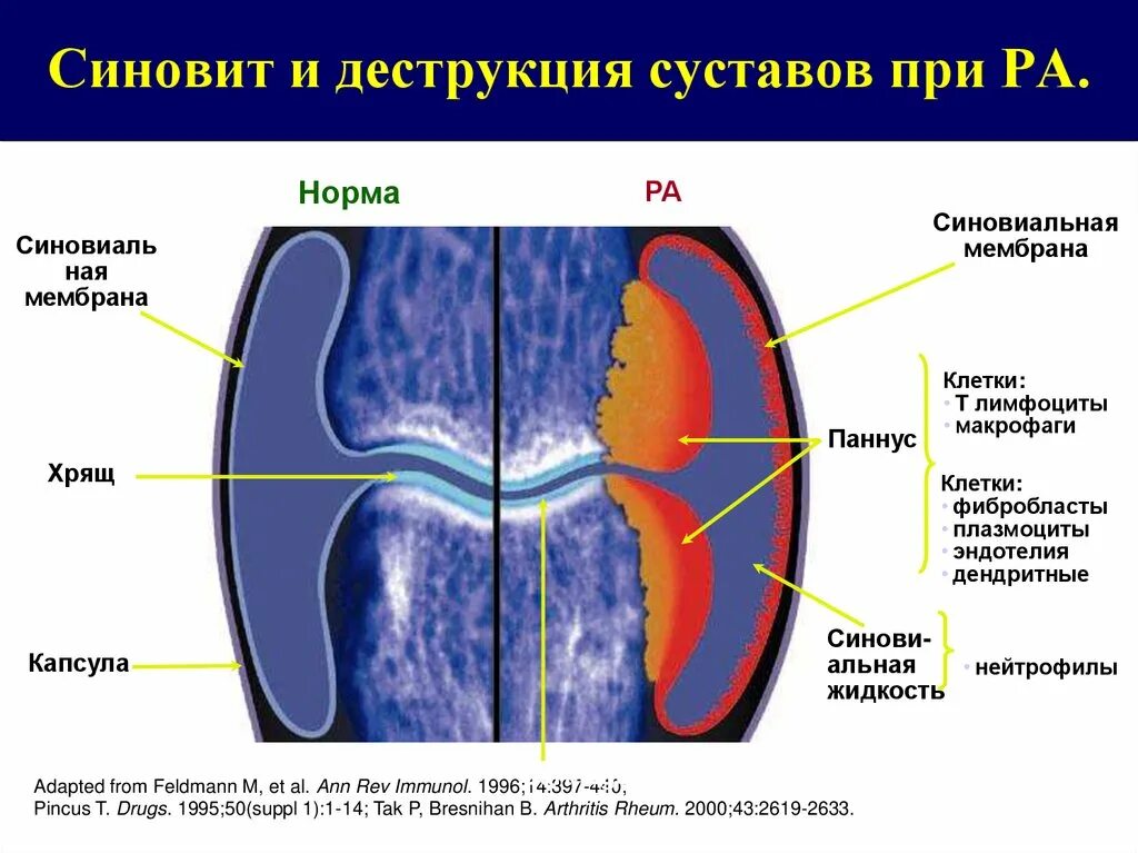 Синовиальная оболочка мрт. Синовит коленного сустава на кт. Синовит синовиальная оболочка.