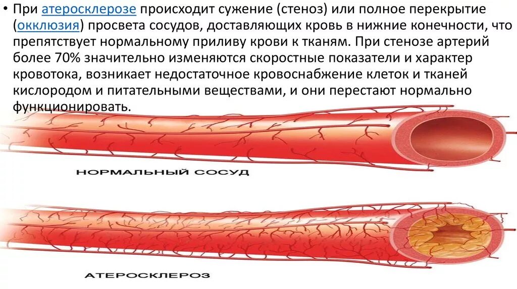 Атеросклероз венечных артерий сердца. Атеросклероз (закупорка кровеносных сосудов). Сужение просвета сосудов. Сужение и расширение сосудов. Расширение кожных сосудов уменьшает