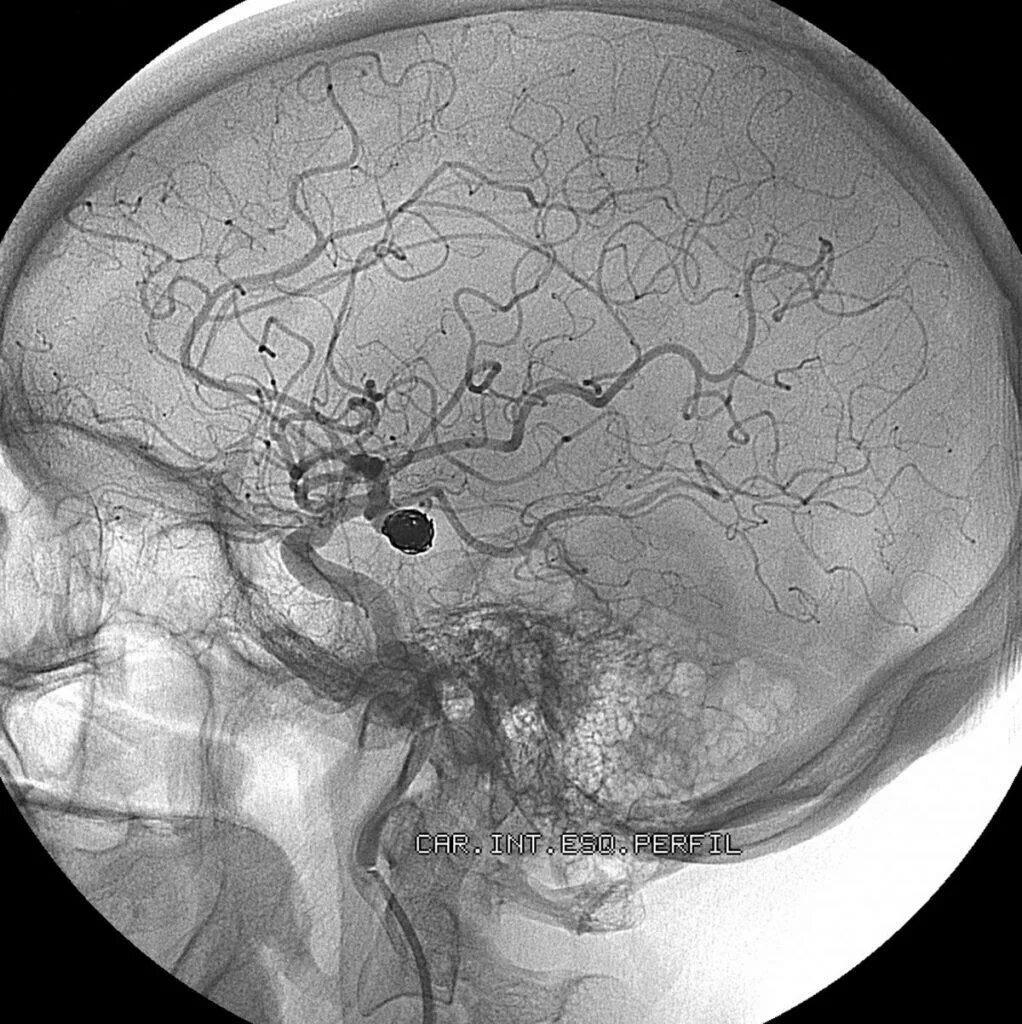 Аневризма головного мозга на кт. Ангиография аневризма. Аневризма сосудов мозга. Эмболизация аневризмы сосудов головного мозга.