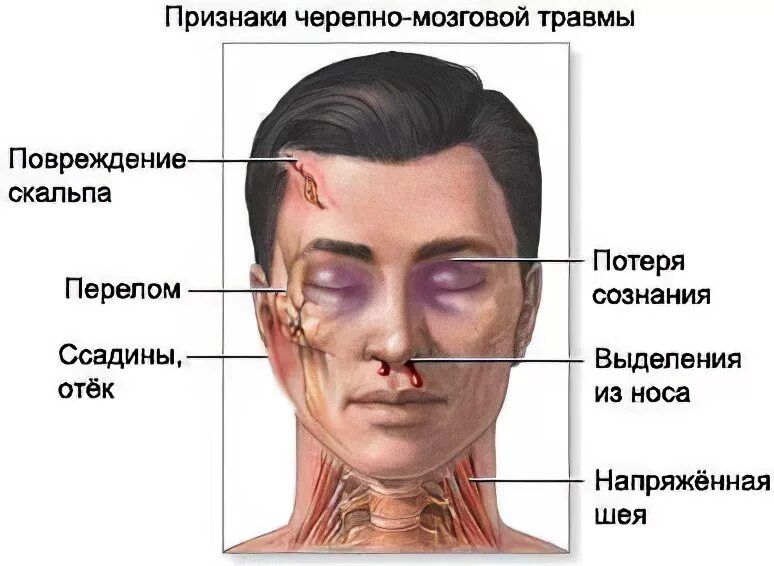 Сотрясение 6. Признаки черепно-мозговой травмы. Клинические проявления ЧМТ. Признаки закрытой черепно-мозговой травмы. Черепно-мозговая травма сотрясение головного мозга.