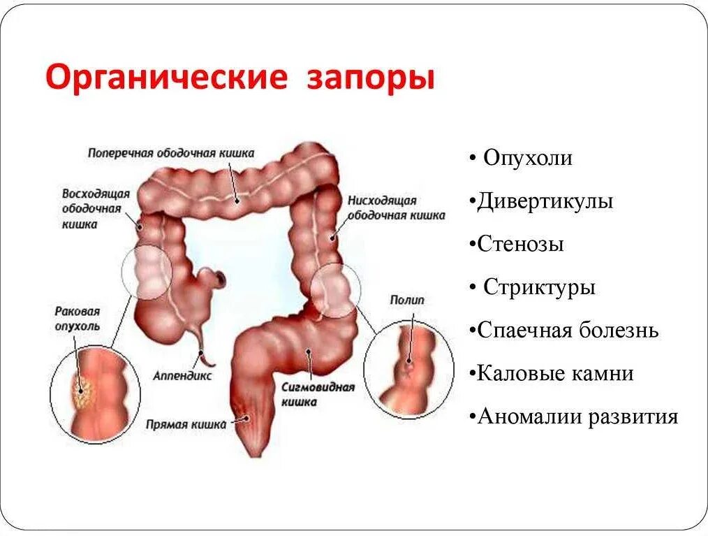 Запор больно. Запор.