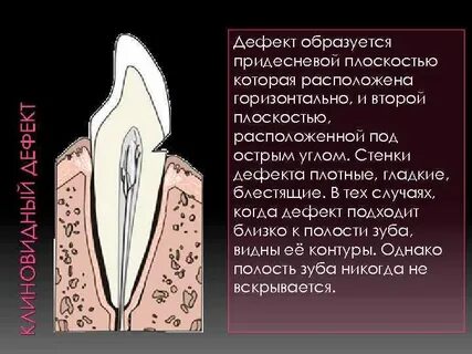Образовавшийся дефект