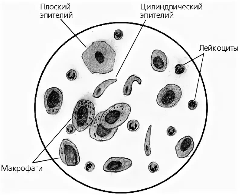 Плоский эпителий в мокроте микроскопия. Клетки цилиндрического эпителия в мокроте. Клетки мокроты нативный препарат. Цилиндрический эпителий в мокроте.