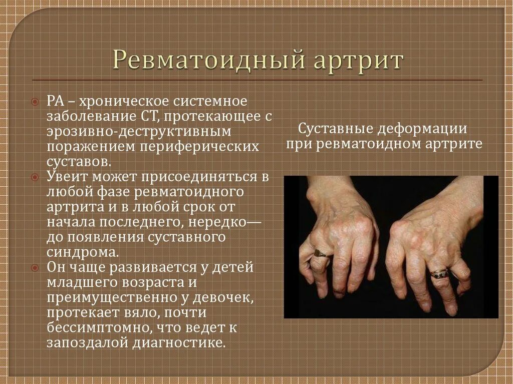 Эрозивный ревматоидный артрит. Ревматоидный артрит през. Псориатический артрит рентген. Системные заболевания соединительной ткани. Эрозивный ревматоидный артрит.