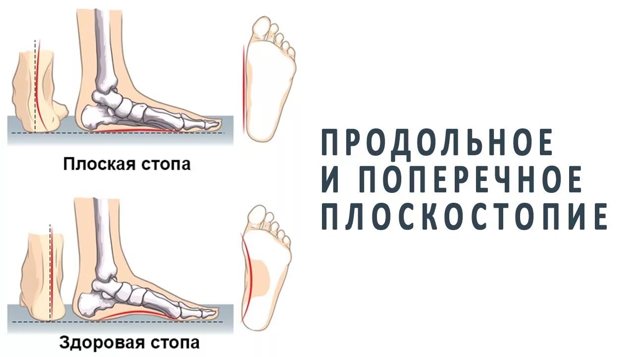 Опущение сводов стопы
