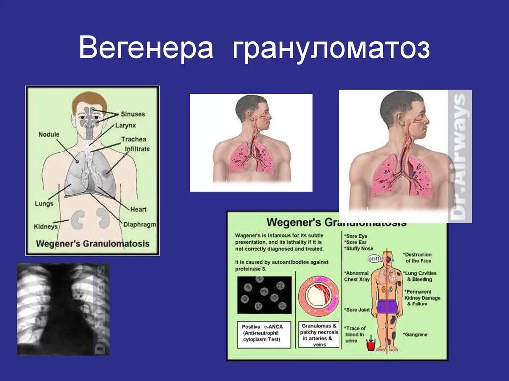 Васкулит вегенера