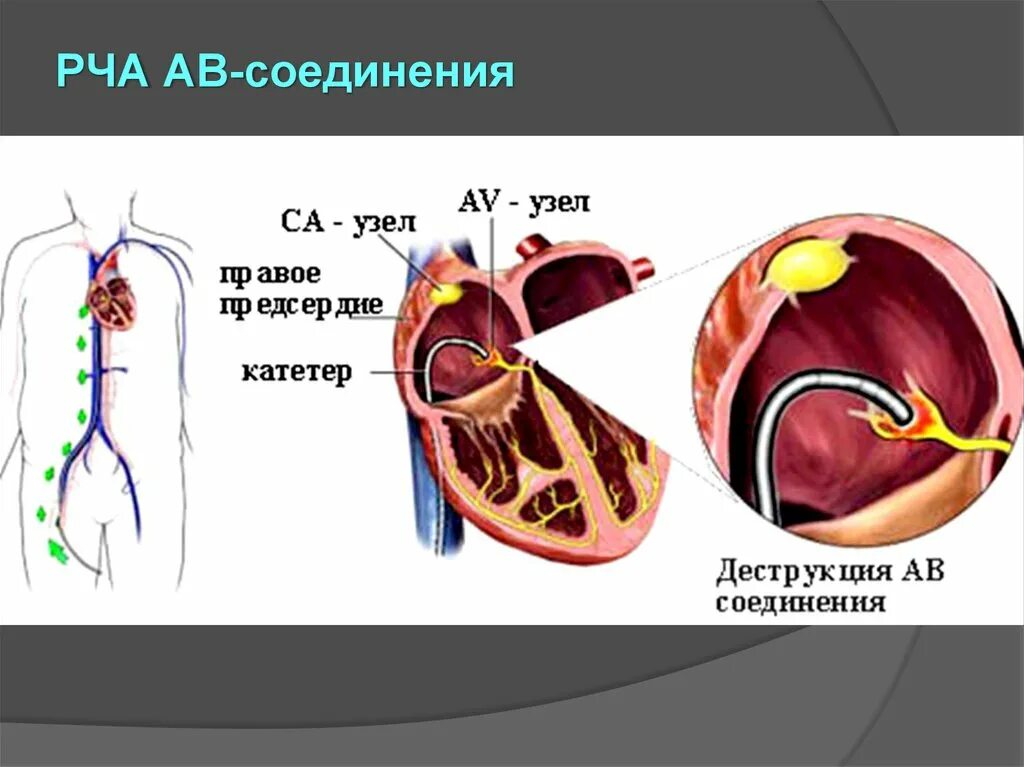 Рча предсердий. Радиочастотная абляция аритмия. Радиочастотная аблация аритмий сердца. Радиочастотная катетерная абляция. Радиочастота катетерная облачия.