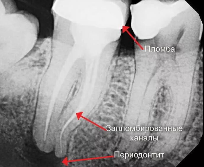Периодонтит запломбированные каналы. Гуттаперча периодонтит. Временное пломбирование корневых