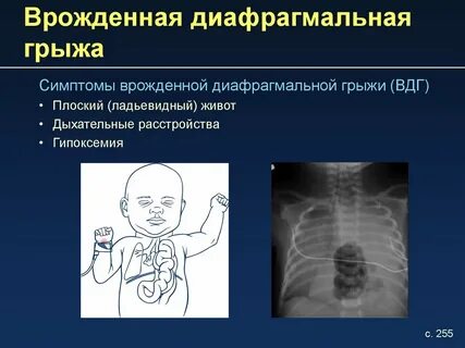 Диафрагмальные грыжи рекомендации