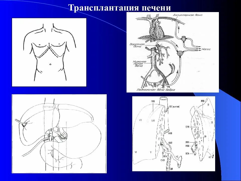 Операция гипертония. Трансплантация печени портальная гипертензия. Хирургическое лечение портальной гипертензии. Портальная гипертензия и ее осложнения хирургия.