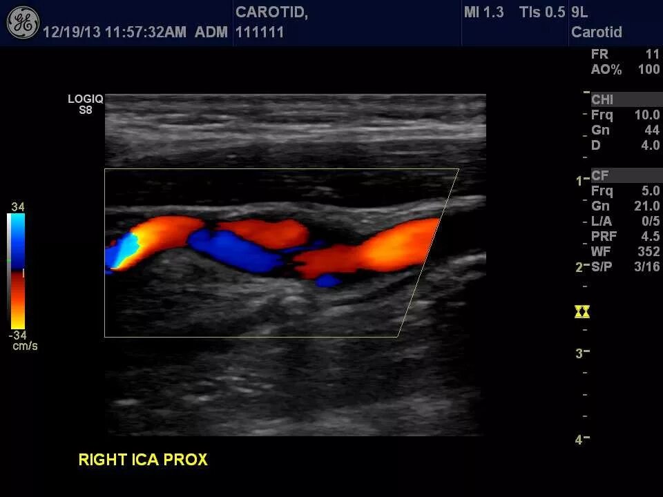 Допплерография ребенку. Цветное допплеровское картирование брахиоцефальных сосудов. Ультразвуковое цветовое дуплексное сканирование. Бца УЗИ сосудов головного мозга. Брахиоцефальные артерии дуплексное сканирование.