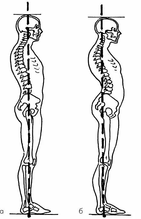 Кашуба биомеханика осанки. Гиперлордоз поясничного отдела позвоночника. Кифозно лордозная осанка. S образная осанка. Прямой позвоночник без изгибов