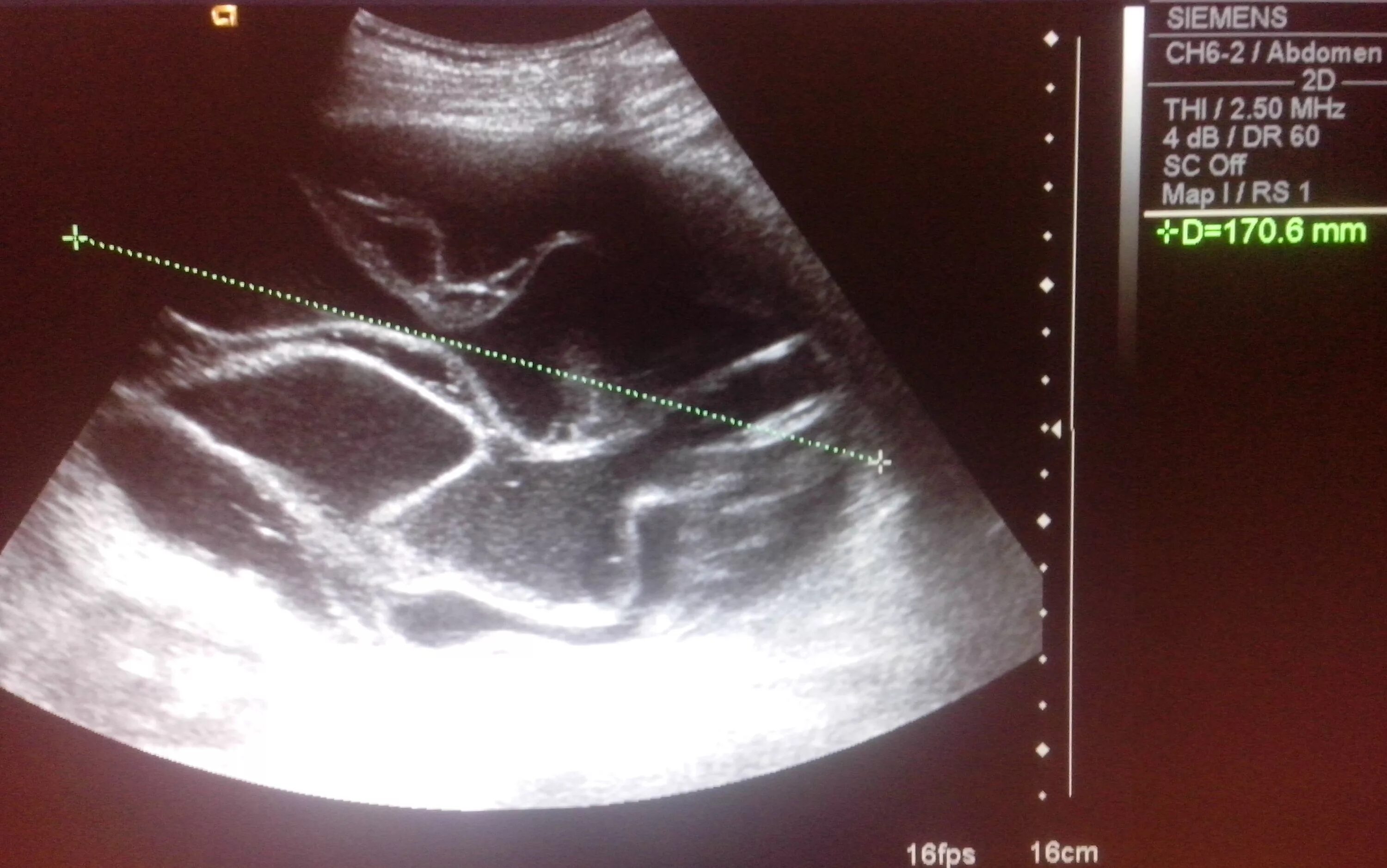 Чрескожная гепатохолангиография. Паразит лямблия симптомы. Паразиты живущие в желчном. Паразиты живущие в желчном. Паразиты в желчном пузыре.