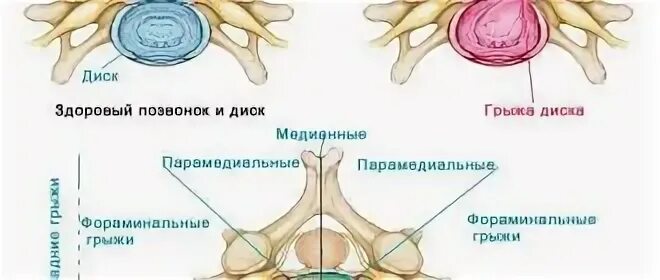 Медианно парамедианная билатеральная. Дорсальная парамедианная грыжа диска с5-с6. Левосторонняя парамедианная грыжа диска l5-s1. Парамедианно-фораминальная грыжа диска l5-s1. Задняя левосторонняя парамедианная грыжа диска.