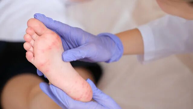 Guidelines for prevention & care of children with hand, foot and mouth disease V