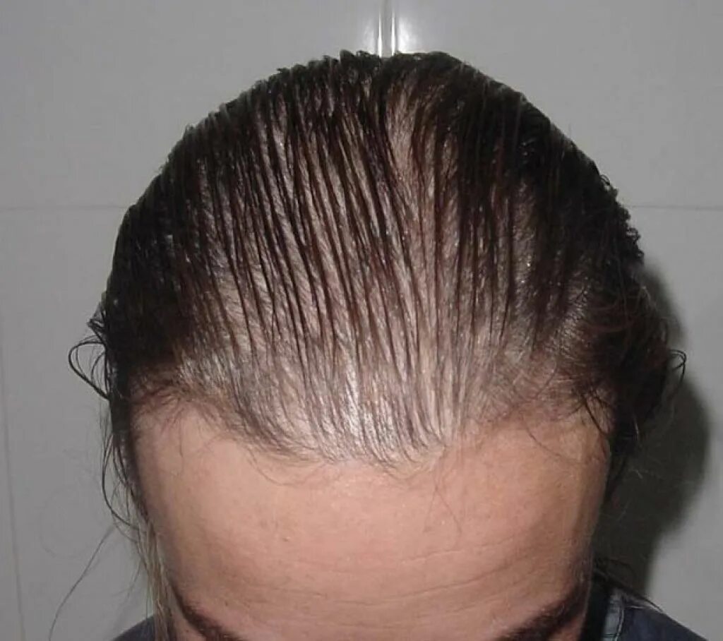 Волосы выпадают короткими. Андрогенная алопеция алопеция. Диффузное телогеновое алопеция.