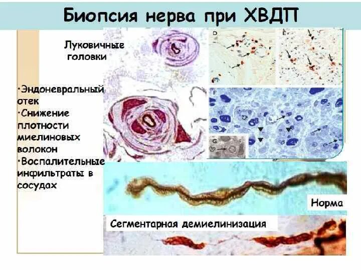 Хроническая демиелинизирующая полинейропатия. Хронические воспалительные Демиелинизирующие полиневропатии. Хроническая воспалительная демиелинизирующая полирадикулопатия. Хроническая воспалительная демиелинизирующая полинейропатия ХВДП.